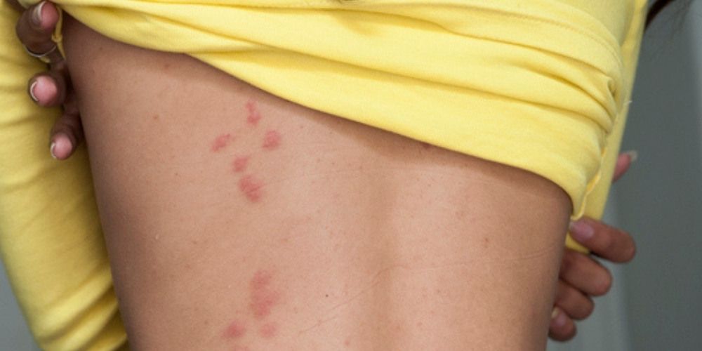 Why Bed Bug Bites Are Often Mistaken for Mosquito Bites