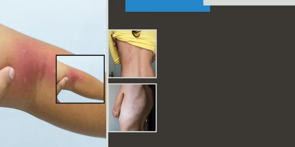 Key Differences Between Mosquito and Bed Bug Bites