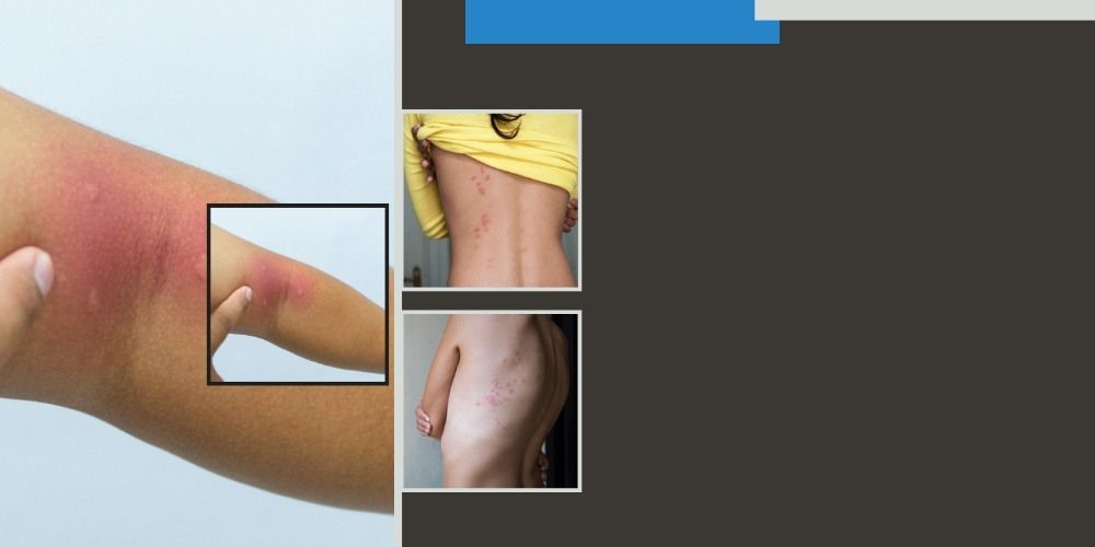 Key Differences Between Mosquito and Bed Bug Bites