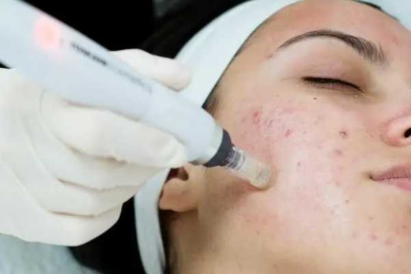 Tratamientos Específicos (Acné, Rosácea, Melasma, Arrugas)