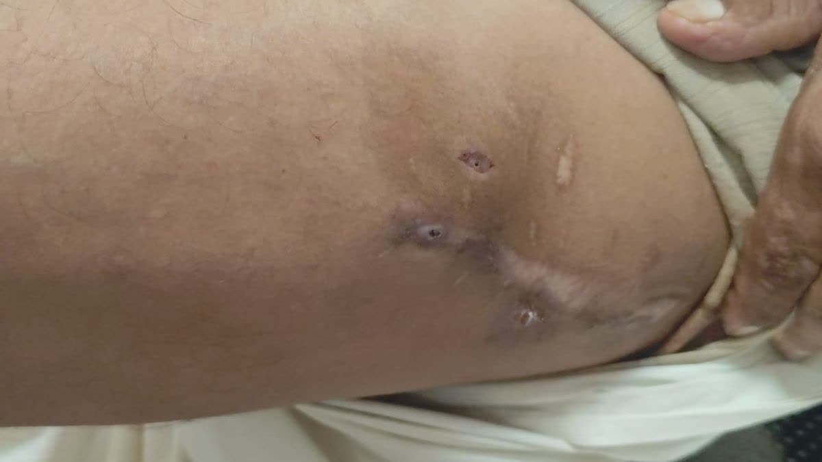 माइसेटोमा के इलाज के लिए जापानी ड्रग का जोधपुर में ट्रायल, जानिए क्या है ये बीमारी