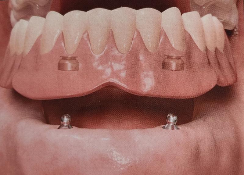 Implantatproteser