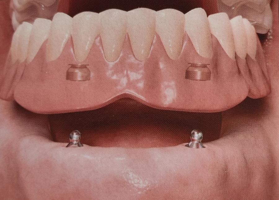 Implantatproteser