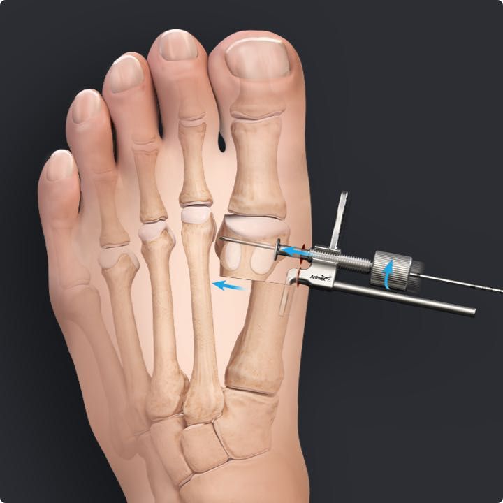 centrolock-mis-bunion-surgery-under-local-anaesthetic