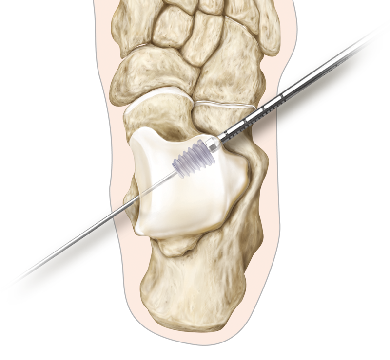 minimially-invasive-flat-foot-mis