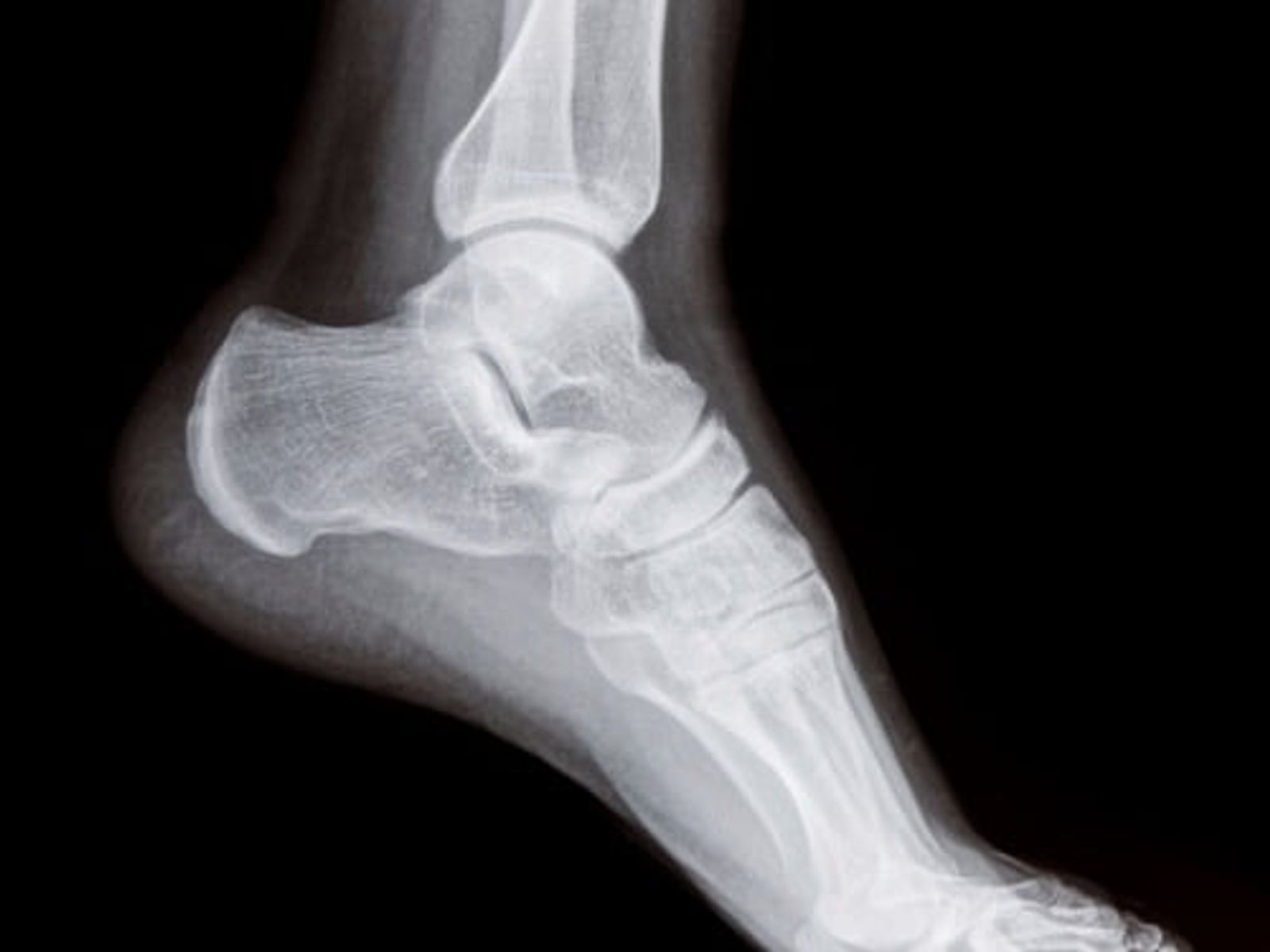 X-ray of right foot and ankle in lateral view showing bone structures.