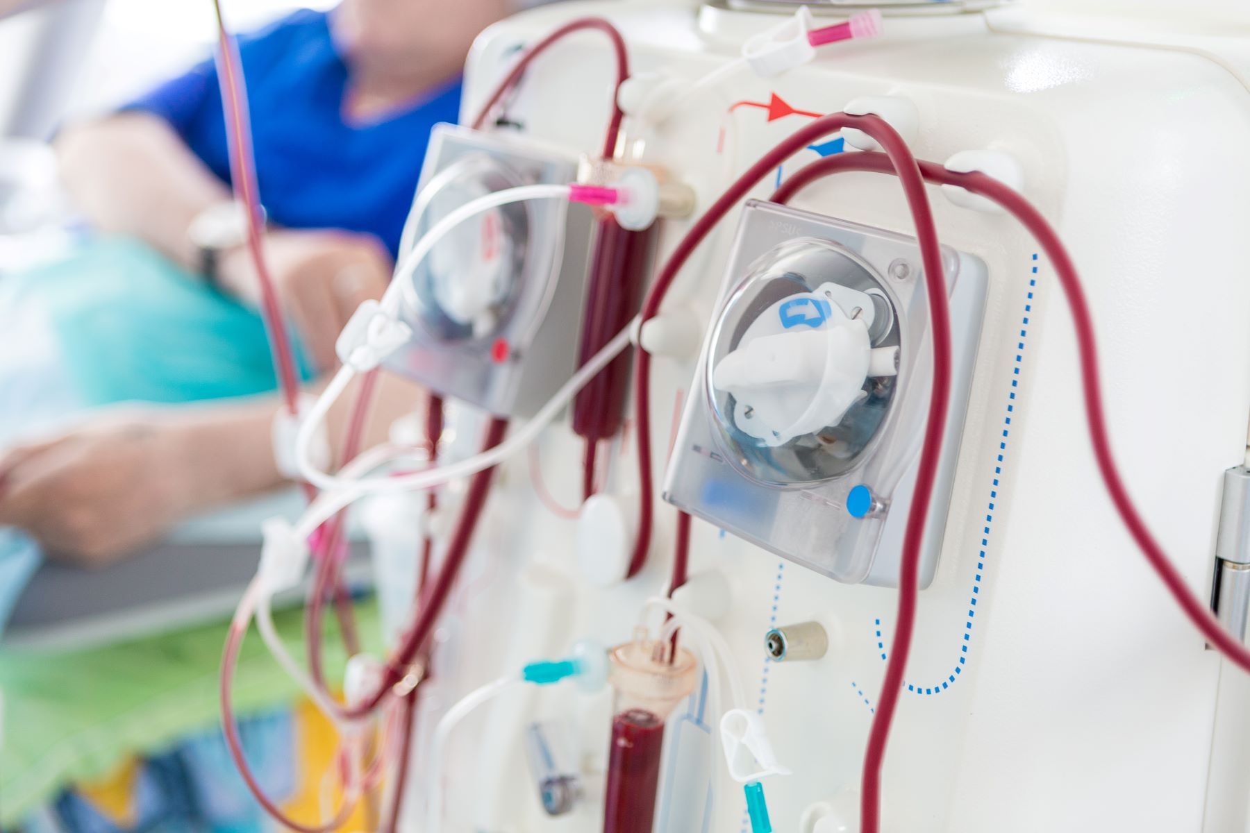 PostKidney Transplant Dialysis Leads to Internal Bleeding Case Study