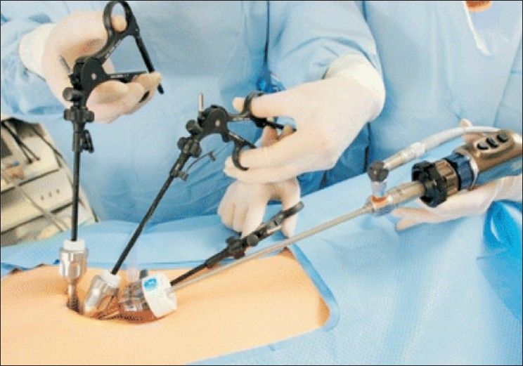 Lab Coli Surgery Laparoscopic cholecystectomy results in biliary damage