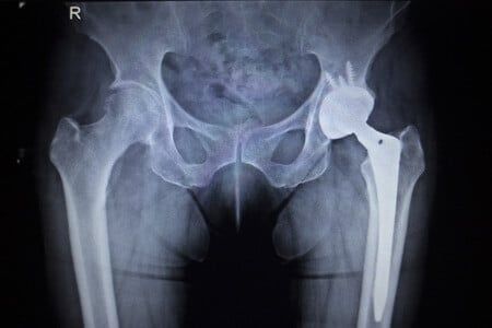 Metal Hip Implant Suffers Catastrophic Failure