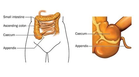 Appendix Rupture Diagram Delayed Diagnosis of Appendicitis Results in Ruptured Appendix