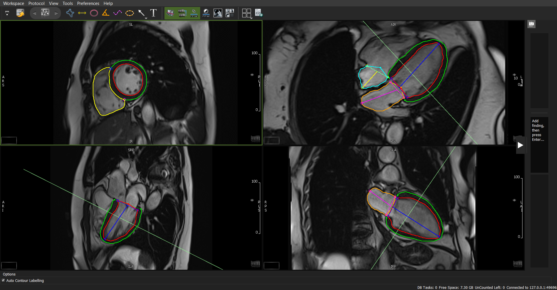 cvi42 Overview | Circle Cardiovascular Imaging