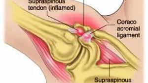 Shoulder impingement anatomy
