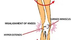 Kneecap / Patella Pain: Can Physiotherapy Help? — figure 4