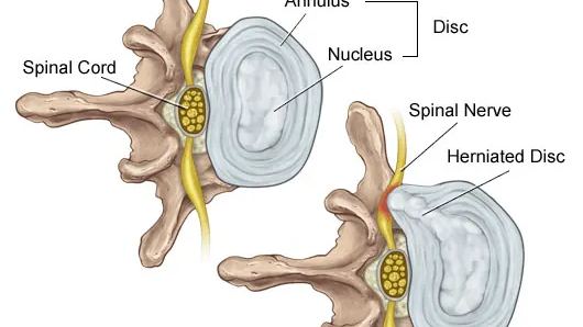Lumbar Disc Bulge