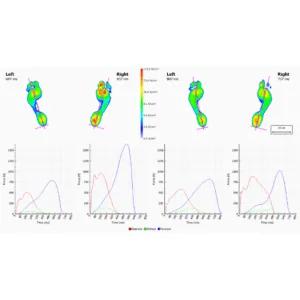 How Footscan Servicing Can Help with Foot and Ankle Pain — figure 4