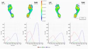 How Footscan Servicing Can Help with Foot and Ankle Pain — figure 4