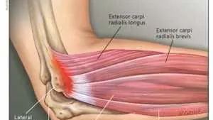 tennis elbow anatomy