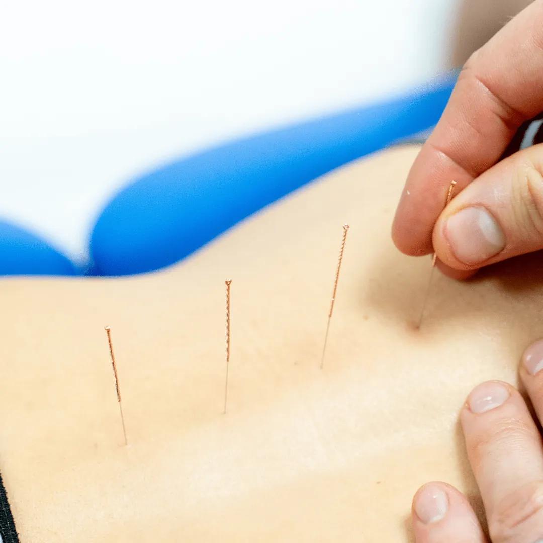 Featured image for Acupuncture – unlock the benefits!