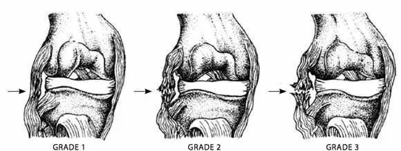 Ligament injury grades