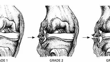Ligament injury grades