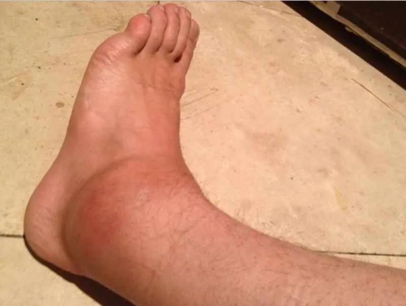 swollen ankle