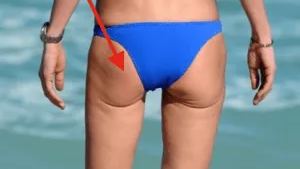 Kneecap / Patella Pain: Can Physiotherapy Help? — figure 2