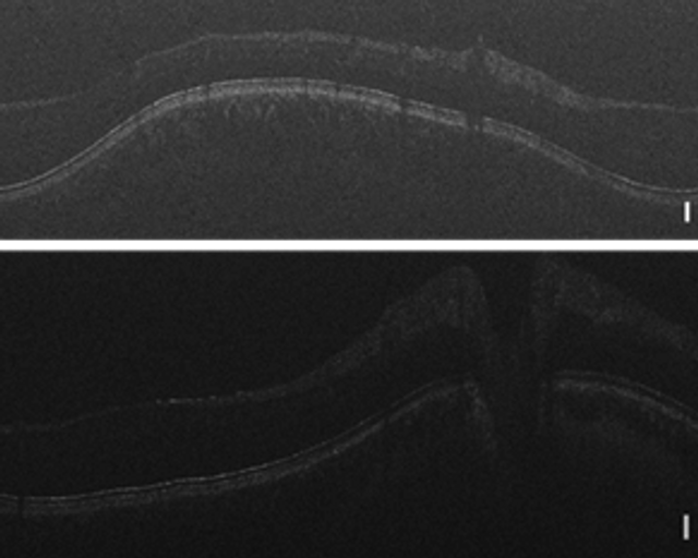 1 µm axial resolution images of a human volunteer taken with a GALAHAD PS OCT device