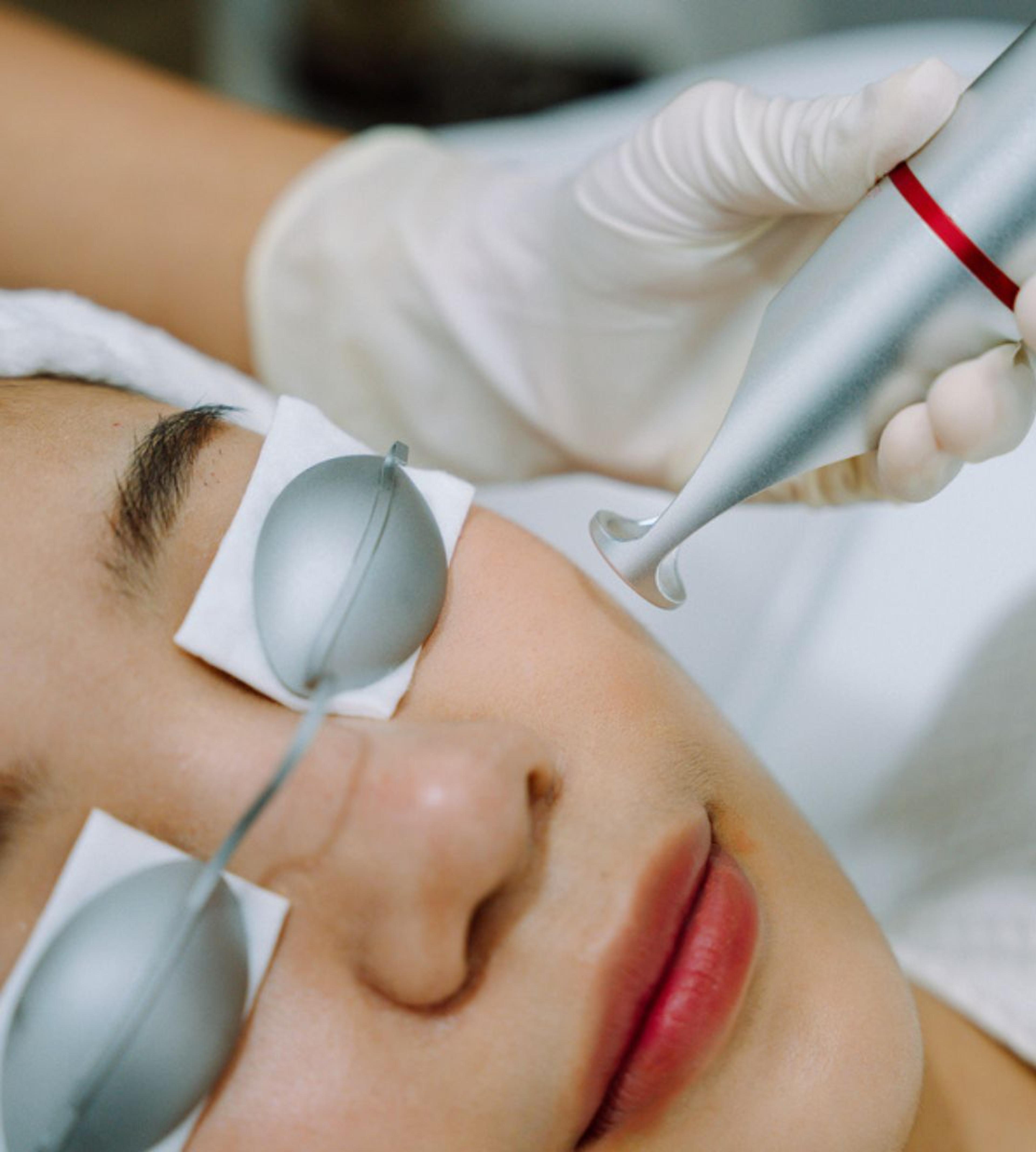 laser treatment - Close-up of a woman receiving a facial laser treatment. She is lying down with protective metal eye shields secured over her eyes and a gloved hand holds a silver handheld laser device near her cheek.