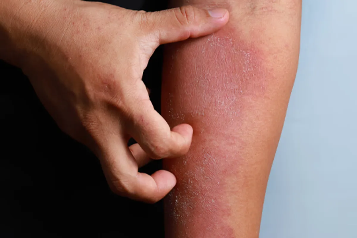 Sequential Skin Microbiome