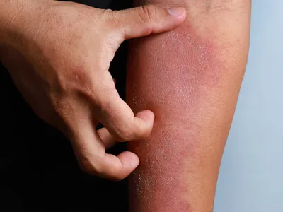 Sequential Skin Microbiome