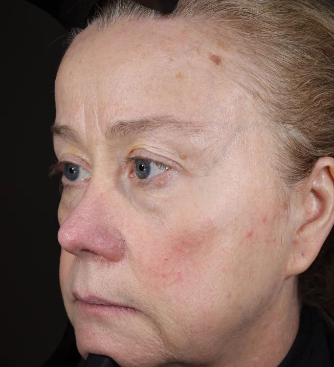 Right profile of a woman's face with fair skin, showing redness on her nose and cheeks, and moles on her forehead.