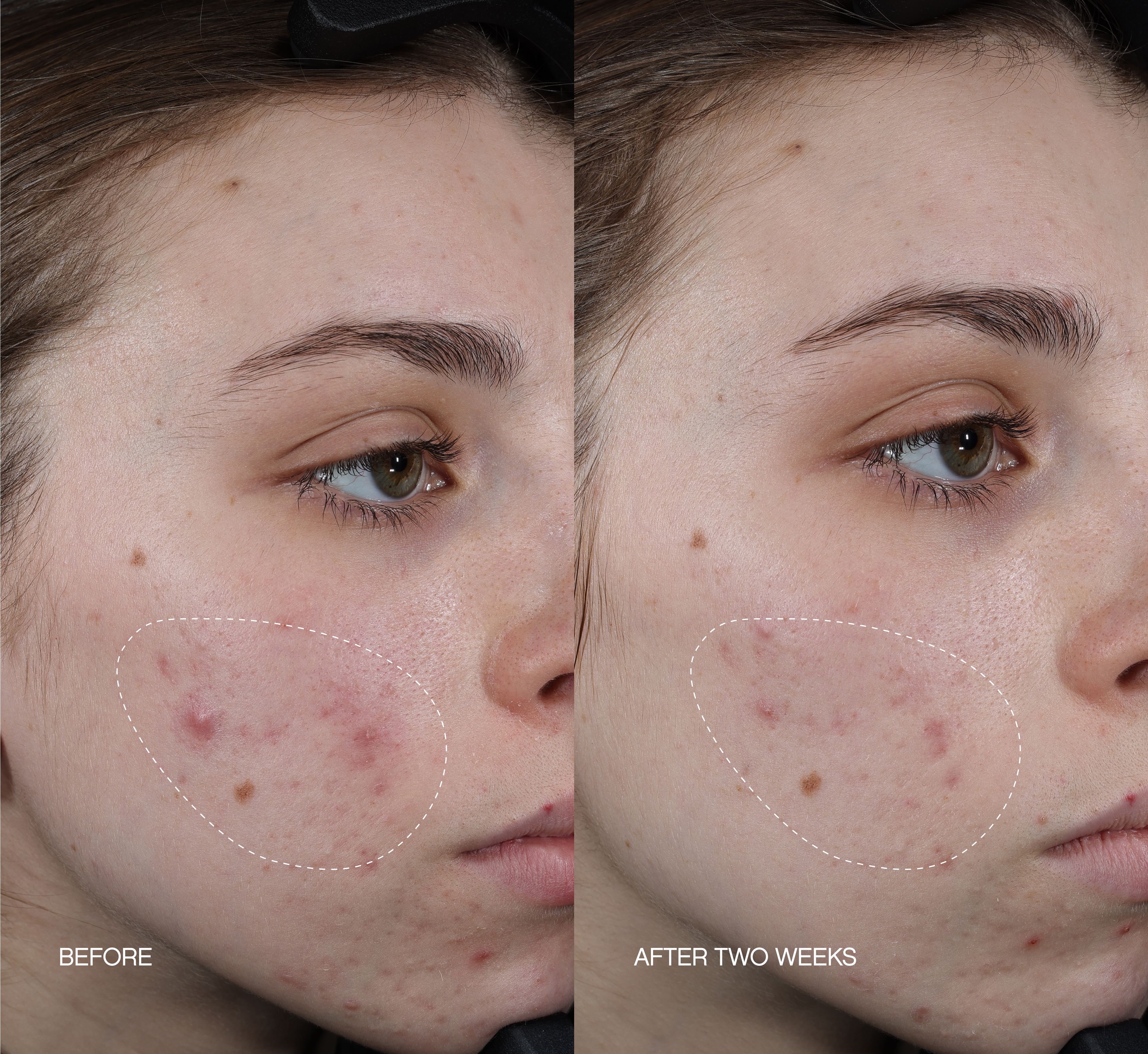 Before and after image of a person's cheek showing a reduction in acne and redness over two weeks.