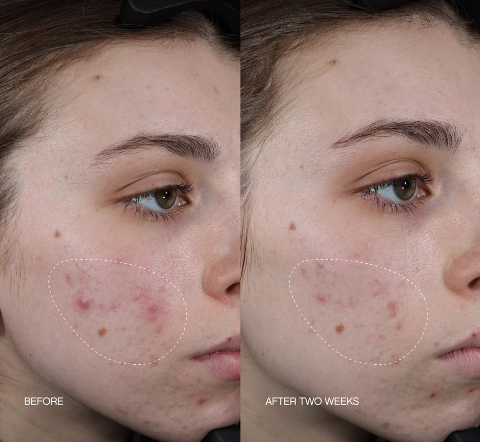 Before and after image of a person's cheek showing a reduction in acne and redness over two weeks.