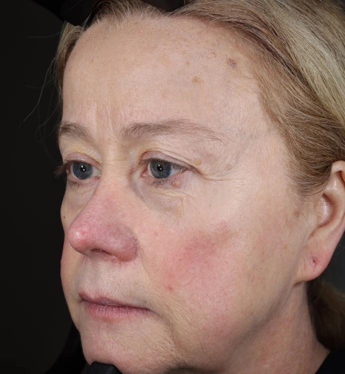 A close-up side profile of a woman's face, featuring fair skin with some redness on her cheek and nose.