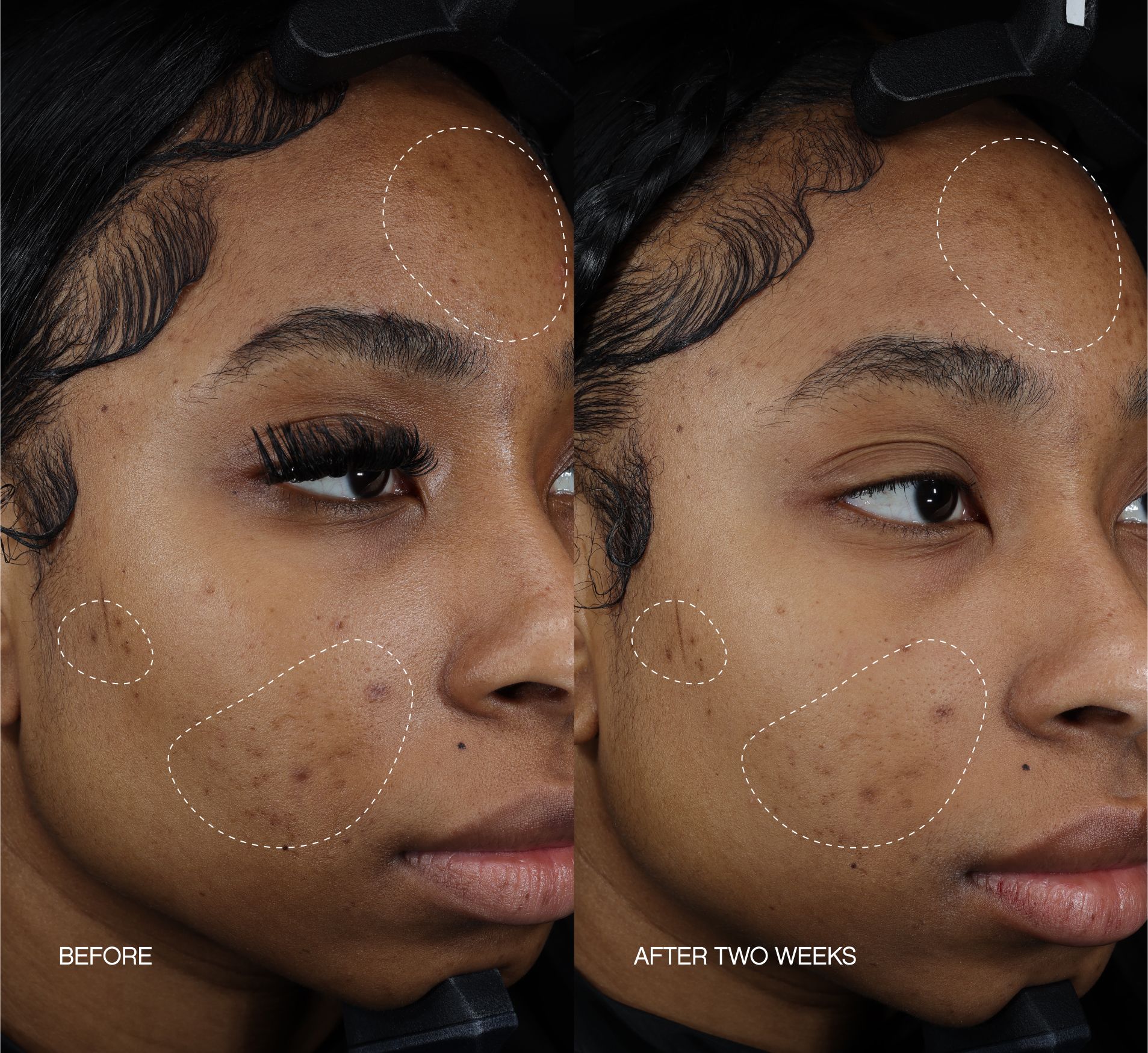 a before and after photo of a woman 's face with acne .