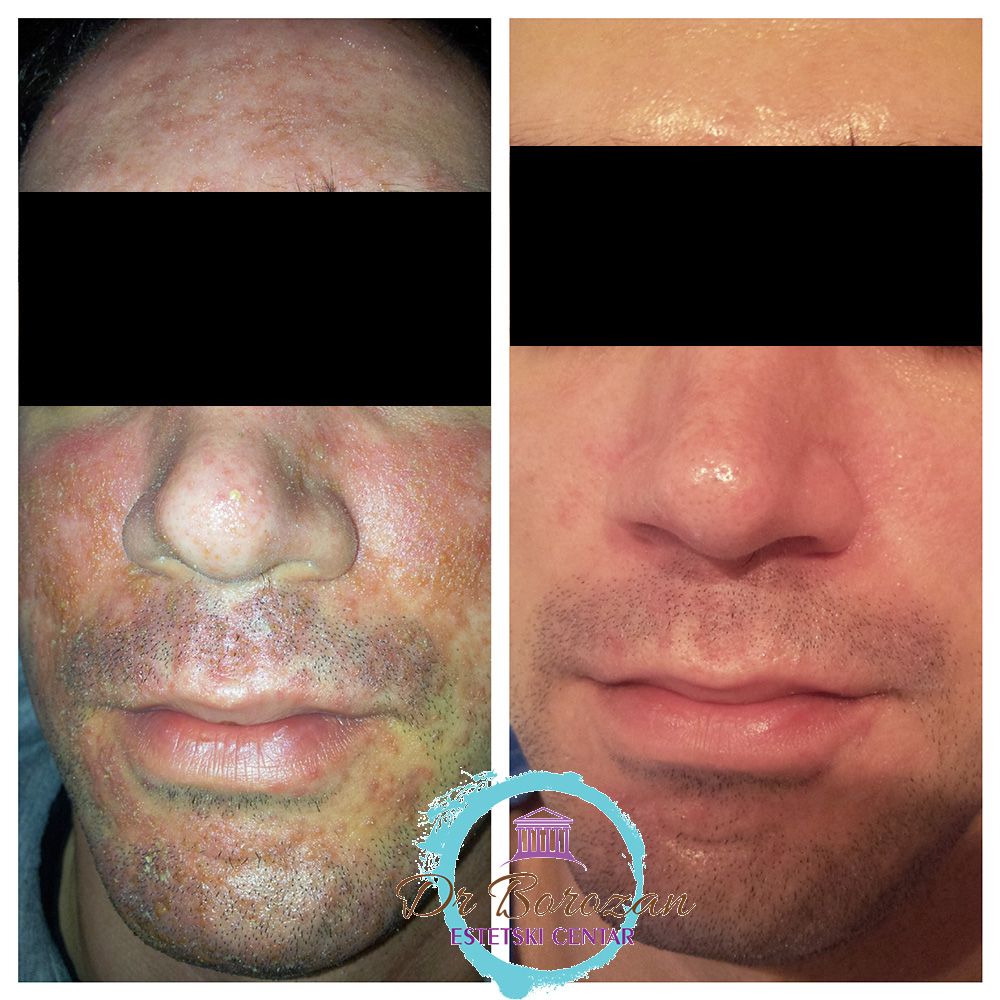 Seboroični dermatitis dijagnostika i klinička slika