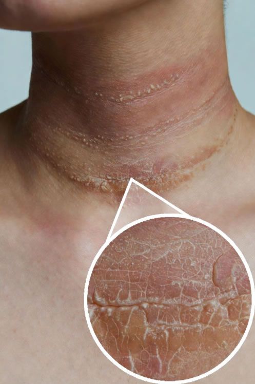 NEURODERMATITIS (Lichen Simplex Chronicus): Uzroci i Lečenje