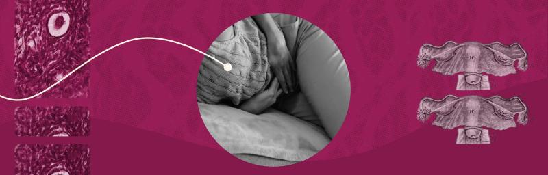 ENDO-205: The New Non-Hormonal Endometriosis Treatment Entering Clinical Trials