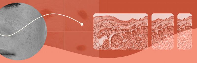 Don't Skip Your Yearly Skin Exam: A Crucial Step for Your Health