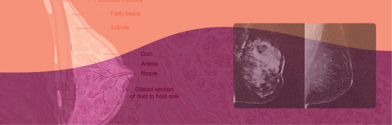 Breast Pain & Cancer Risk
