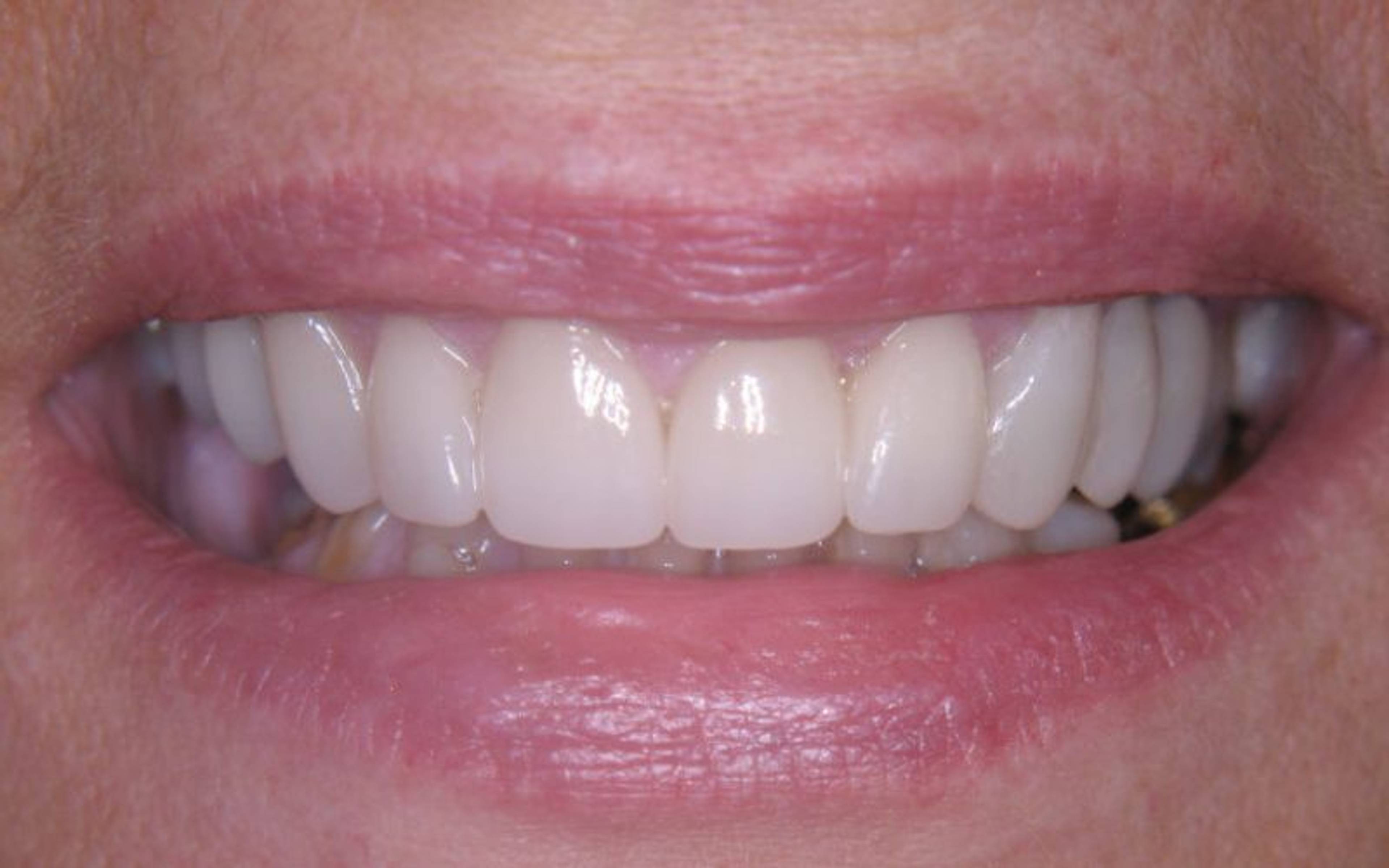 How does a dental crown work?