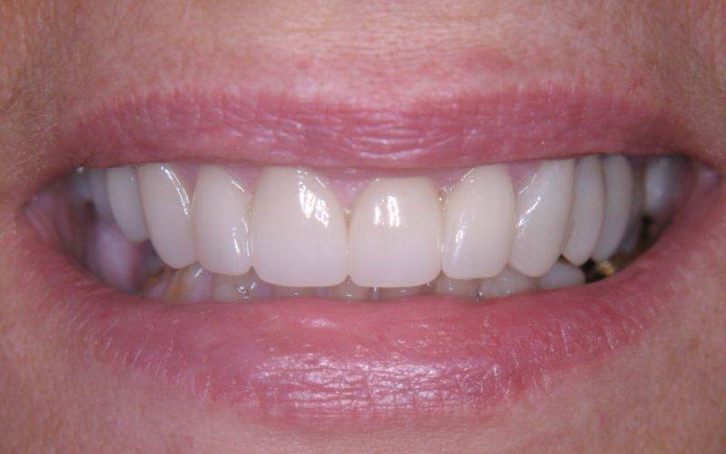 How does a dental crown work?