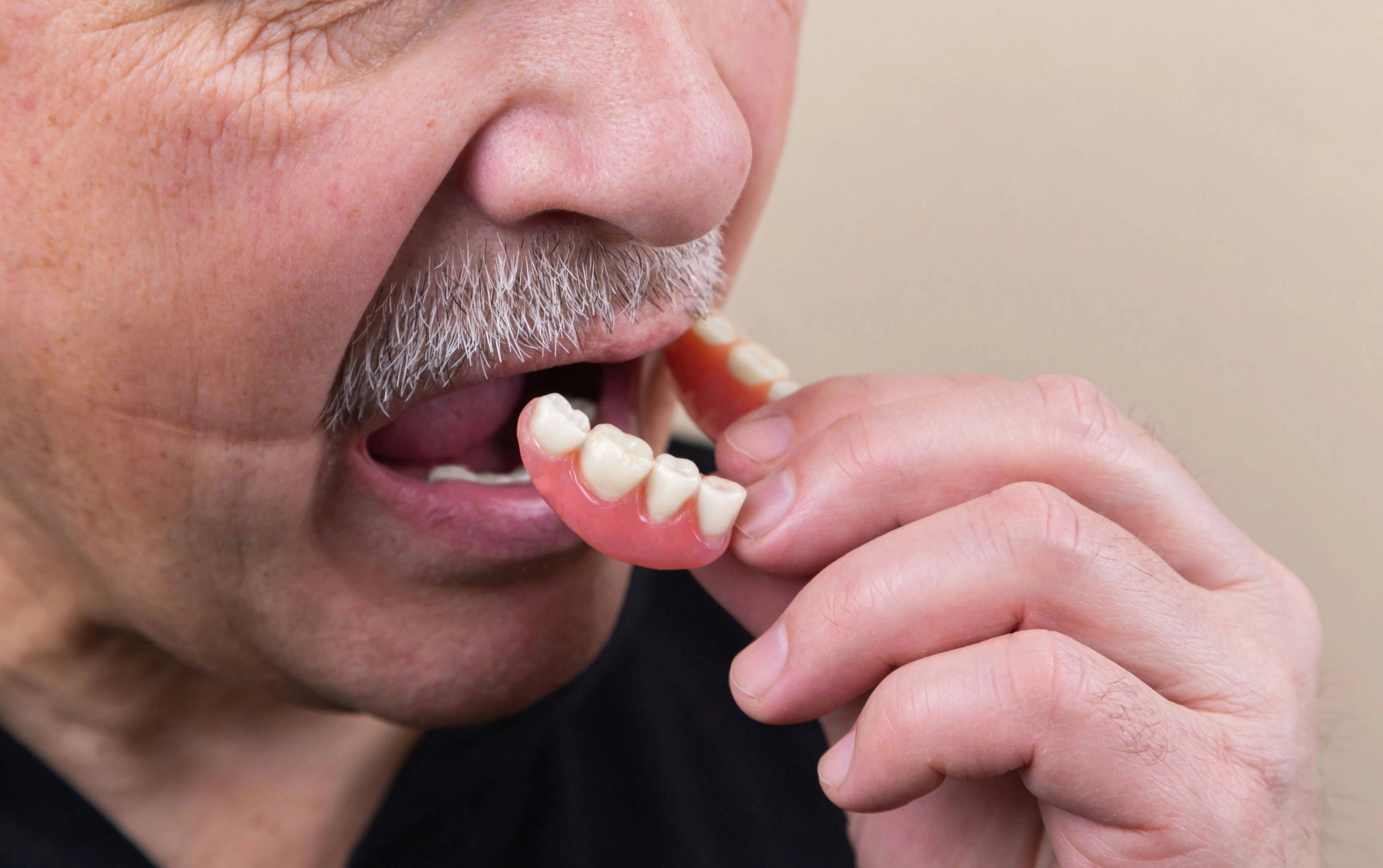 A stock photo of an older patient putting partial dentures in his mouth