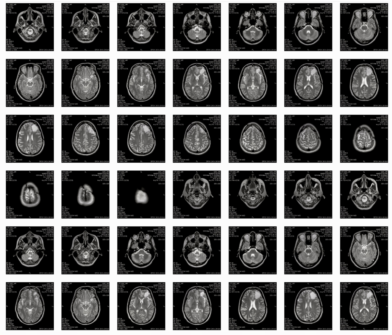 Evelin Maier's neurological MRI scans of 2014/2015. 