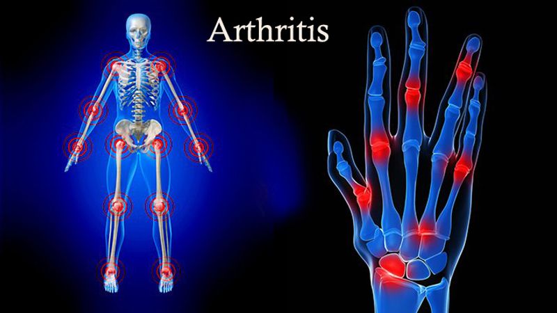 arthritis