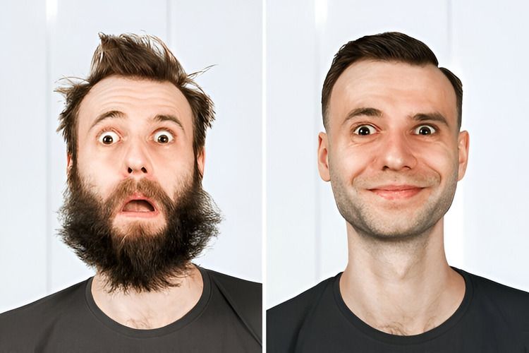 beard transplant before and after