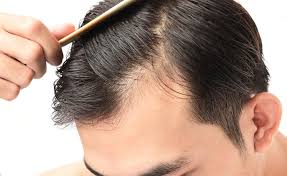Men's Hair Loss Therapy
