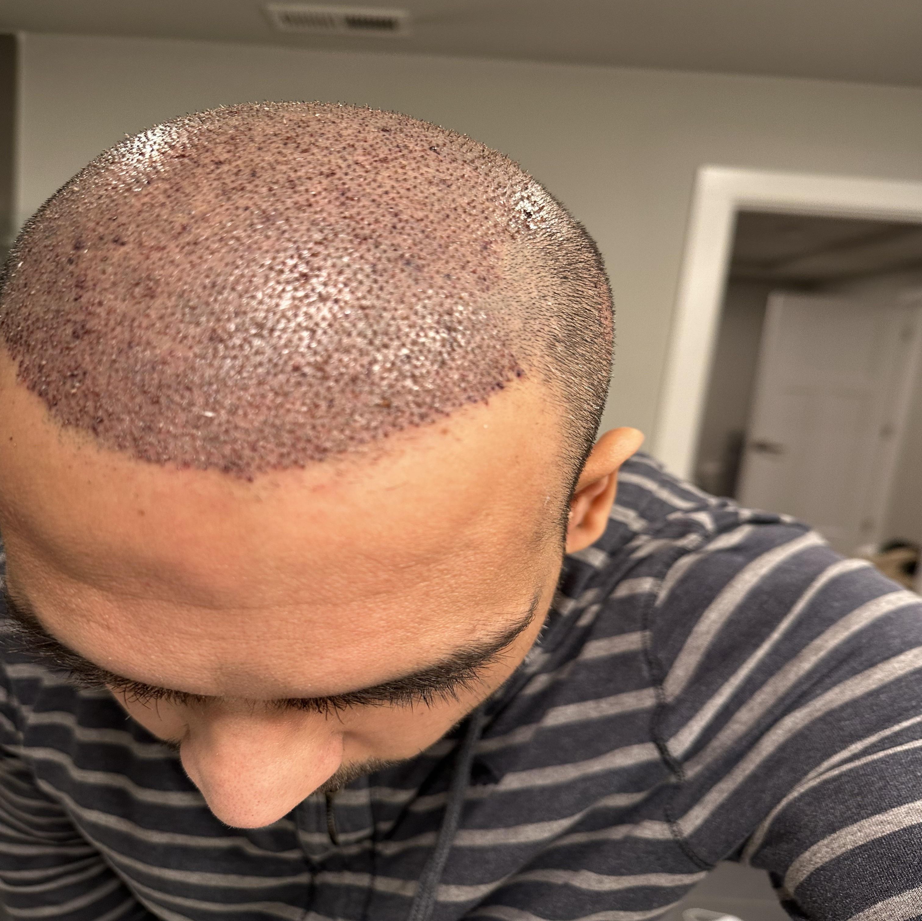 Day 1–3: Initial Healing Phase hair transplant