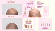 Best Hair Transplant UK Modern Hair Loss Restoration HGC Best Hair Transplant UK Modern Hair Loss Restoration HGC