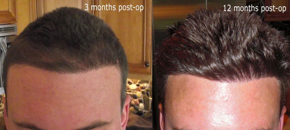 Months 12: Seeing the Full Results Hair Transplant